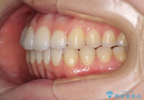オープンバイトのインビザラインを用いた再矯正 の治療後
