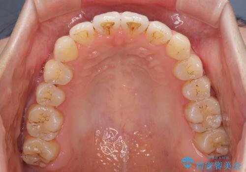 オープンバイトのインビザラインを用いた再矯正 の治療後