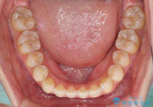 オープンバイトのインビザラインを用いた再矯正 の治療後