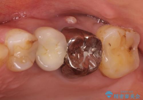 奥歯が痛い。根管治療~オールセラミッククラウンの治療の治療前