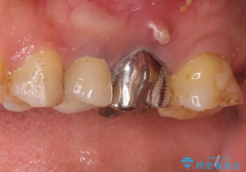 奥歯が痛い。根管治療~オールセラミッククラウンの治療の治療前