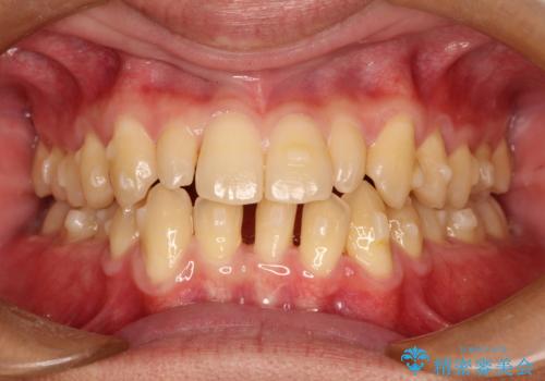 前歯のガタガタの矯正　下顎の前歯を1本抜歯してのインビザライン矯正の治療中