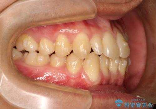 前歯のガタガタの矯正 下顎の前歯を1本抜歯してのインビザライン矯正の治療中