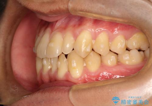 前歯のガタガタの矯正 下顎の前歯を1本抜歯してのインビザライン矯正の治療中