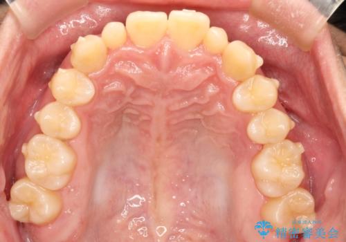 前歯のガタガタの矯正　下顎の前歯を1本抜歯してのインビザライン矯正の治療中