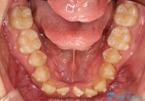 前歯のガタガタの矯正 下顎の前歯を1本抜歯してのインビザライン矯正の治療中