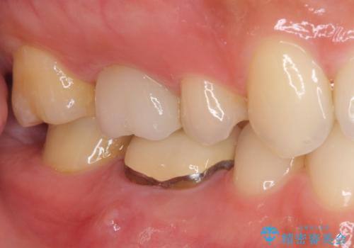 金属の縁が見えてしまったクラウン オールセラミッククラウンで審美的にの治療前