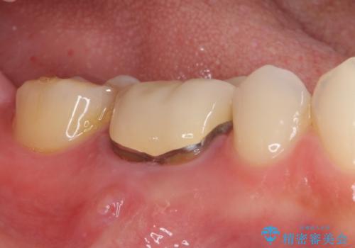 金属の縁が見えてしまったクラウン オールセラミッククラウンで審美的にの治療前