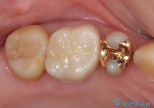 奥歯の深い虫歯をオールセラミックで治療