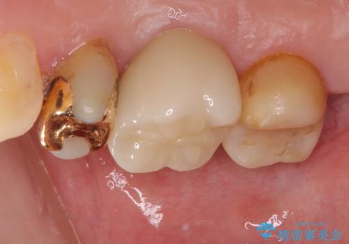 奥歯の深い虫歯をオールセラミックで治療の治療後
