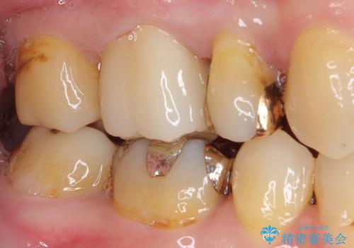 奥歯の深い虫歯をオールセラミックで治療の治療後