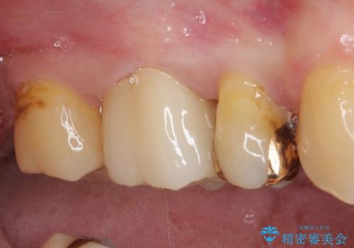 奥歯の深い虫歯をオールセラミックで治療の治療後