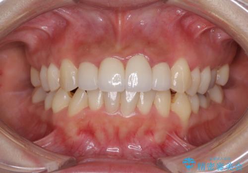 前歯のオールセラミック　腫れている歯肉が改善の治療後