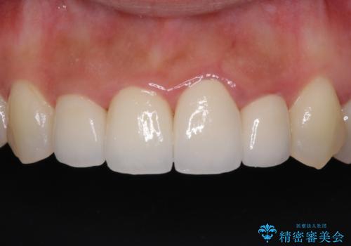前歯のオールセラミック　腫れている歯肉が改善の症例 治療後