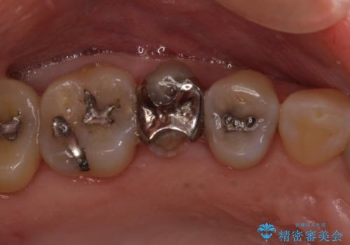 前歯のすきっぱ&奥歯の虫歯 セラミッククラウンで徹底的に治すの治療前