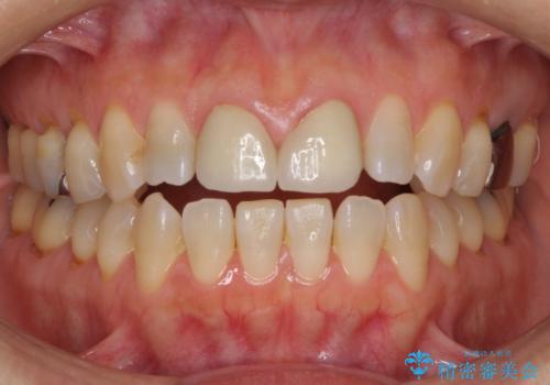 前歯のすきっぱ&奥歯の虫歯 セラミッククラウンで徹底的に治すの治療中