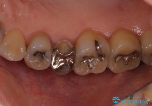 前歯のすきっぱ&奥歯の虫歯 セラミッククラウンで徹底的に治すの治療前