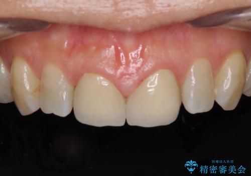 前歯のすきっぱ&奥歯の虫歯　セラミッククラウンで徹底的に治すの治療中