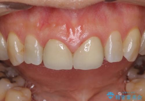 前歯のすきっぱ&奥歯の虫歯 セラミッククラウンで徹底的に治すの治療中
