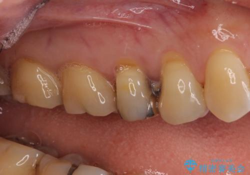 前歯のすきっぱ&奥歯の虫歯　セラミッククラウンで徹底的に治すの治療前