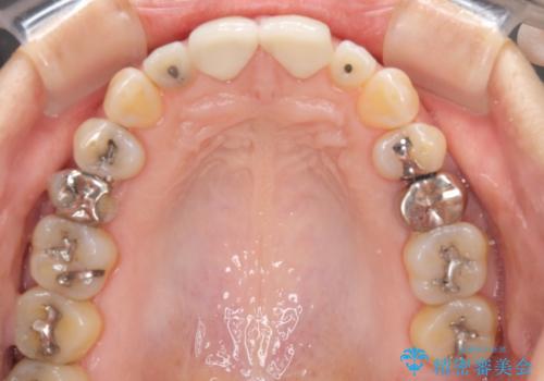 前歯のすきっぱ&奥歯の虫歯 セラミッククラウンで徹底的に治すの治療中