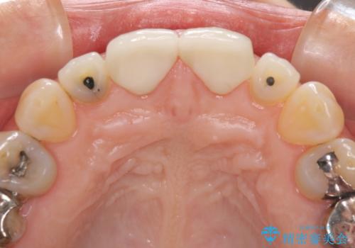 前歯のすきっぱ&奥歯の虫歯 セラミッククラウンで徹底的に治すの治療中