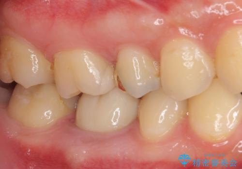 奥歯のむし歯治療 セラミックとゴールドインレーの治療後