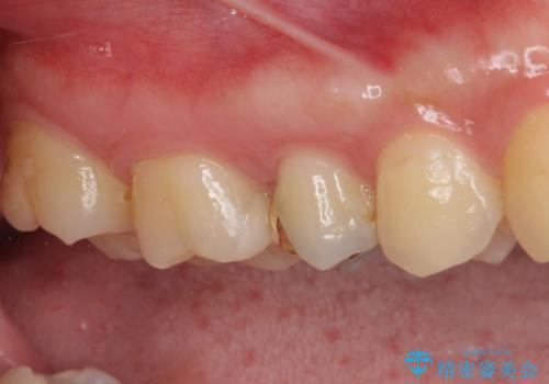 奥歯のむし歯治療 セラミックとゴールドインレーの治療後