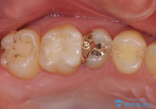 奥歯のむし歯治療　セラミックとゴールドインレーの治療後