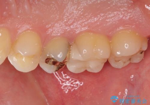 奥歯のむし歯治療 セラミックとゴールドインレーの治療後