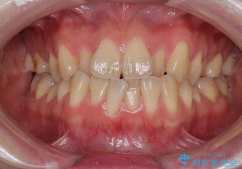 ハーフリンガル 反対咬合の改善の症例 治療前
