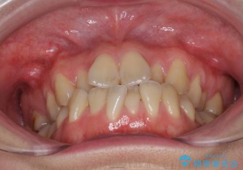 ハーフリンガル 反対咬合の改善の治療前