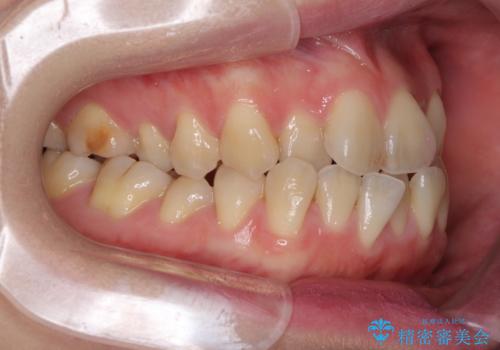 ハーフリンガル 反対咬合の改善の治療前
