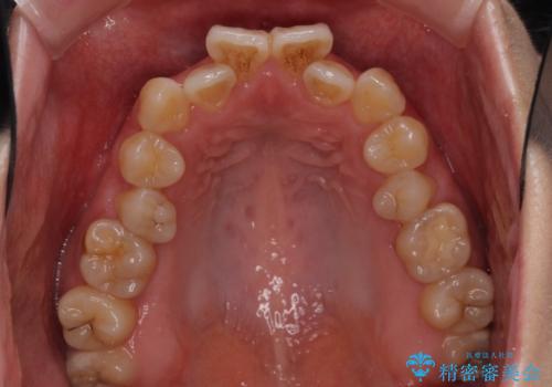 ハーフリンガル 反対咬合の改善の治療前
