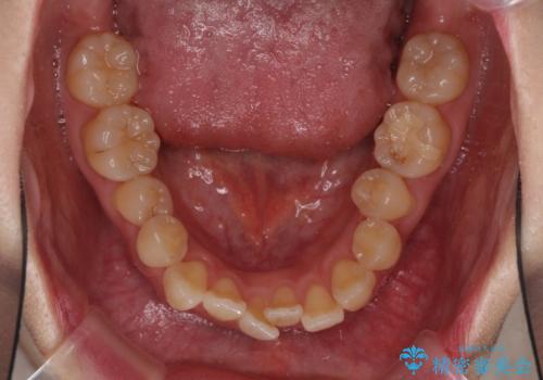 ハーフリンガル 反対咬合の改善の治療前