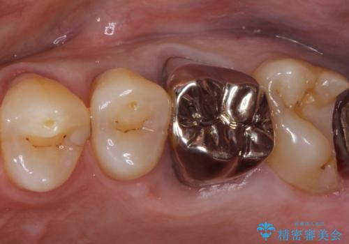 ゴールドインレーによる修復治療の治療中