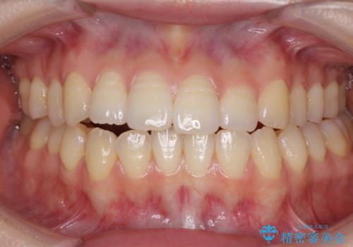 オープンバイトのインビザラインを用いた再矯正 の症例 治療前