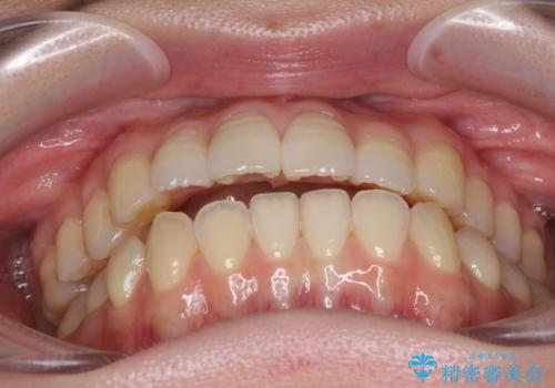オープンバイトのインビザラインを用いた再矯正 の治療前