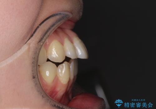 オープンバイトのインビザラインを用いた再矯正 の治療前