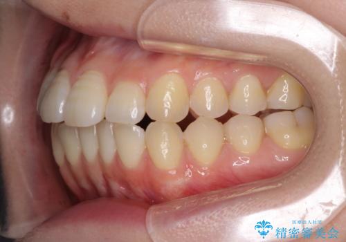 オープンバイトのインビザラインを用いた再矯正 の治療前