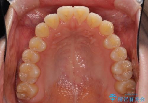 オープンバイトのインビザラインを用いた再矯正 の治療前