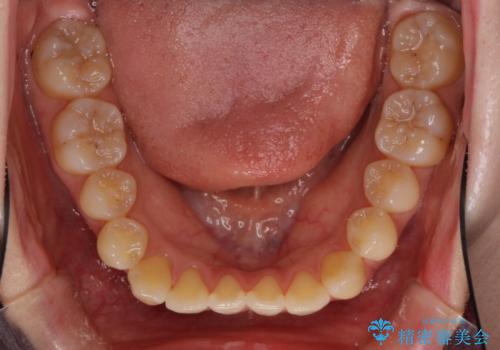 オープンバイトのインビザラインを用いた再矯正 の治療前