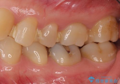 3本仮づめのまま放置 セラミックインレーへの治療前