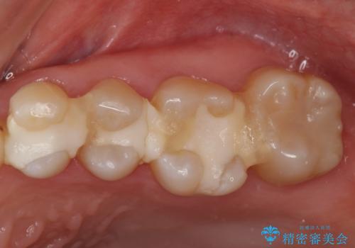 3本仮づめのまま放置 セラミックインレーへの治療前