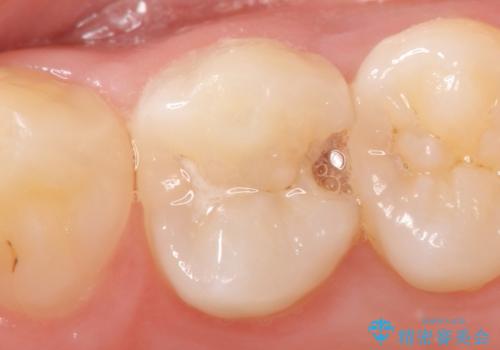 セラミックインレー　虫歯で欠けた歯の治療の症例 治療前