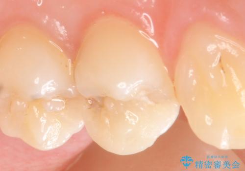 セラミックインレー 虫歯で欠けた歯の治療の治療前