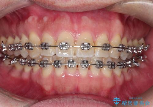 ワイヤーによる全体的ながたつきの矯正治療の治療中