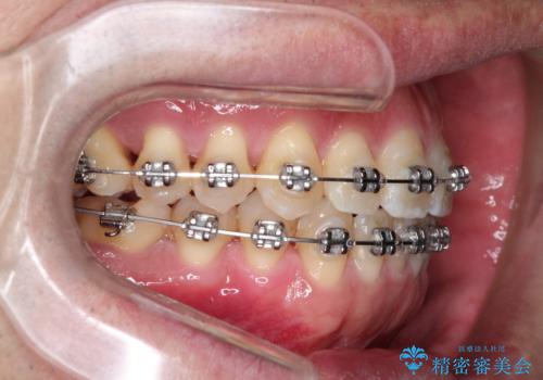 ワイヤーによる全体的ながたつきの矯正治療の治療中