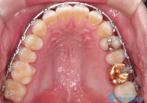 ワイヤーによる全体的ながたつきの矯正治療の治療中