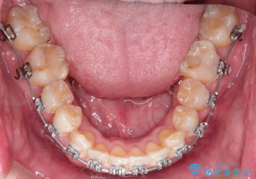 ワイヤーによる全体的ながたつきの矯正治療の治療中